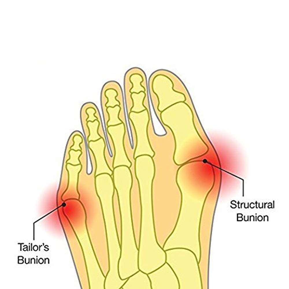 Корректор Вальгусной Деформации Hallux Valgus с Гелевыми Подушечками (Пара) маленький, фото №5 Корректор Вальгусной Деформации Hallux Valgus с Гелевыми Подушечками (Пара) маленький, фото №5