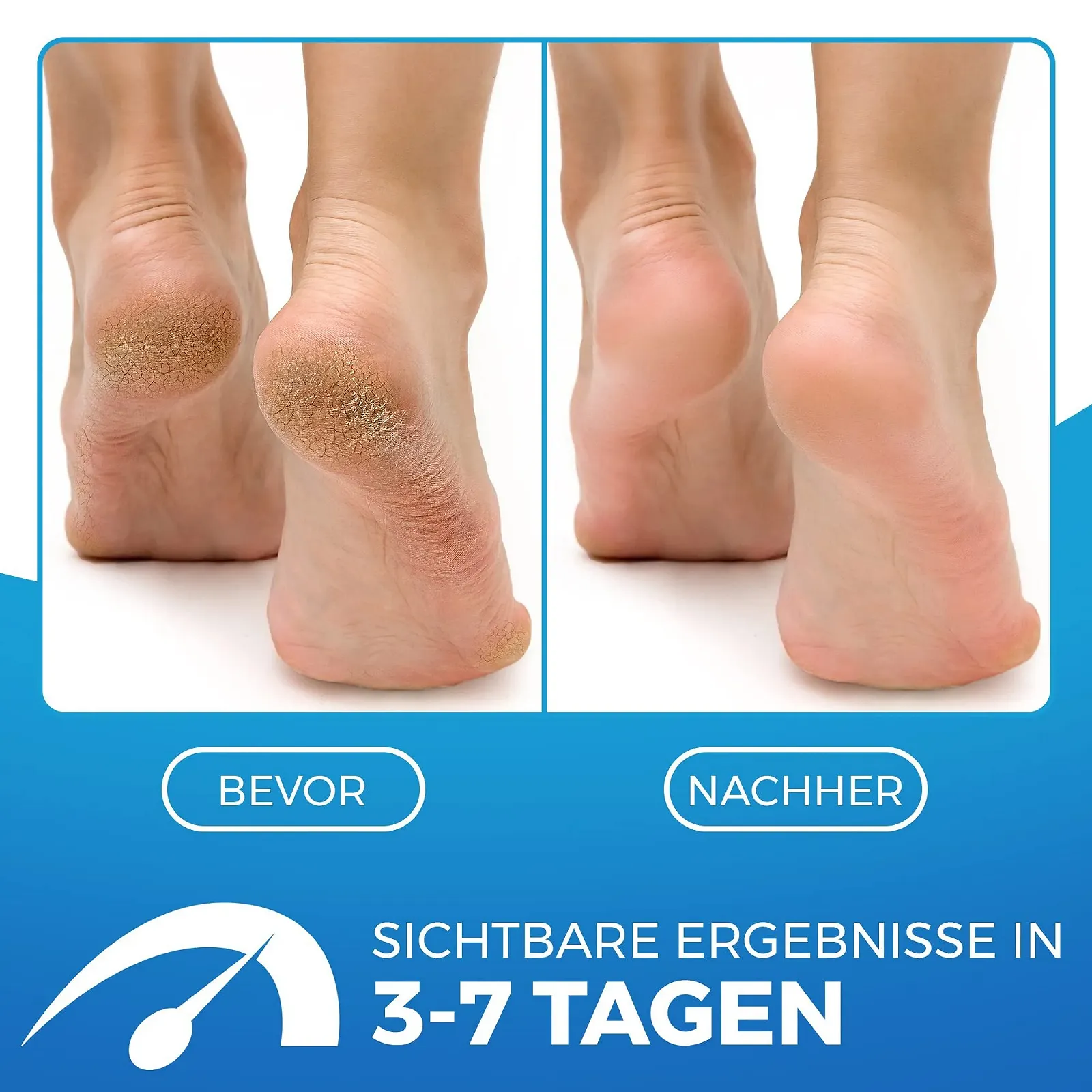 Крем для ног 2-in-1 увлажняющий для потрескавшейся кожи 75 мл., фото №2