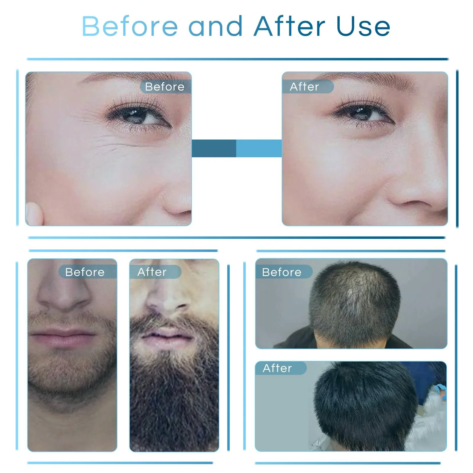 Dr.roller Регульований мікроголковий дермальний штамп, Dermastamp 0-3.0 мм, мікроголкова ручка, фото №5