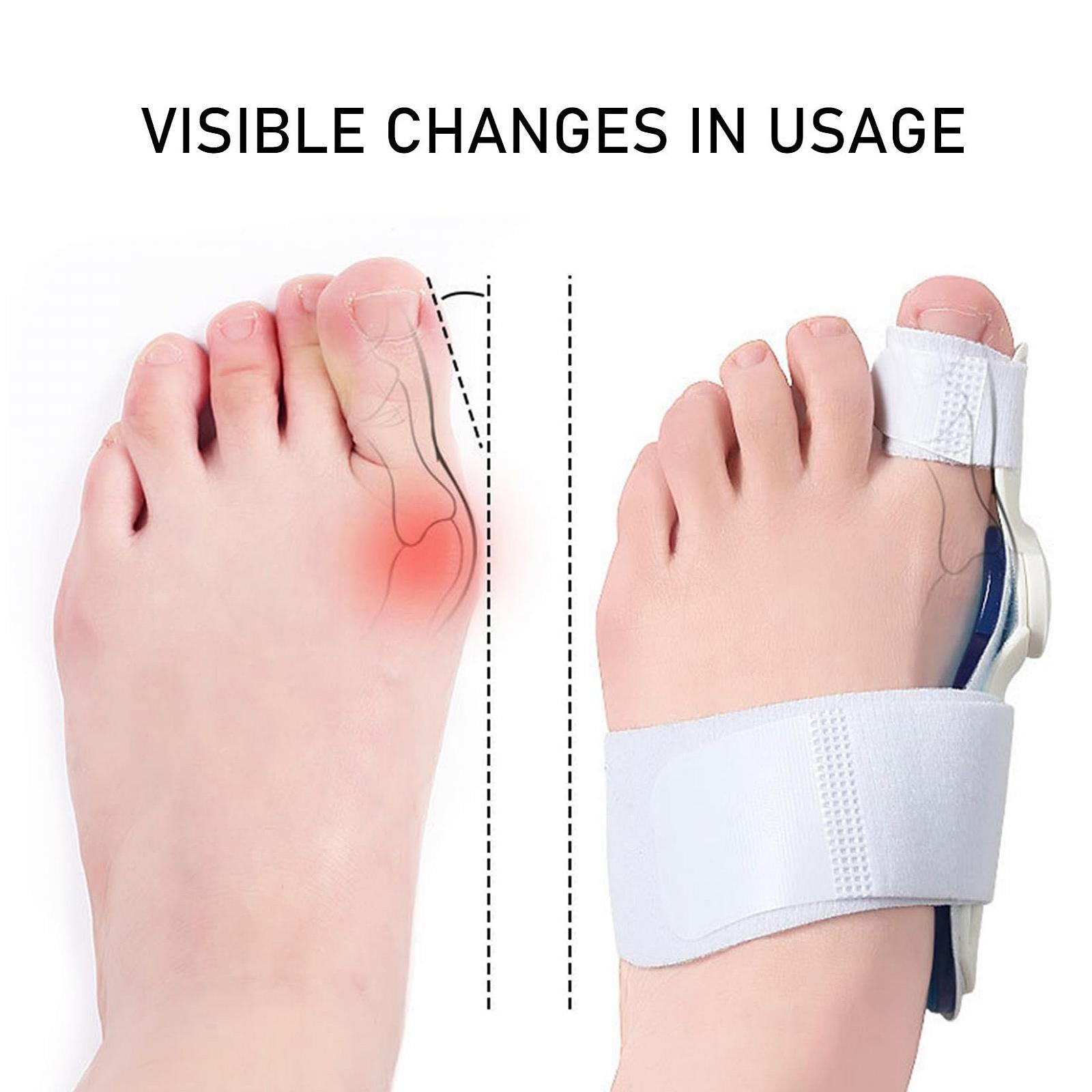 Коректор великого пальця стопи для жінок і чоловіків, випрямляч і роздільник, фото №6
