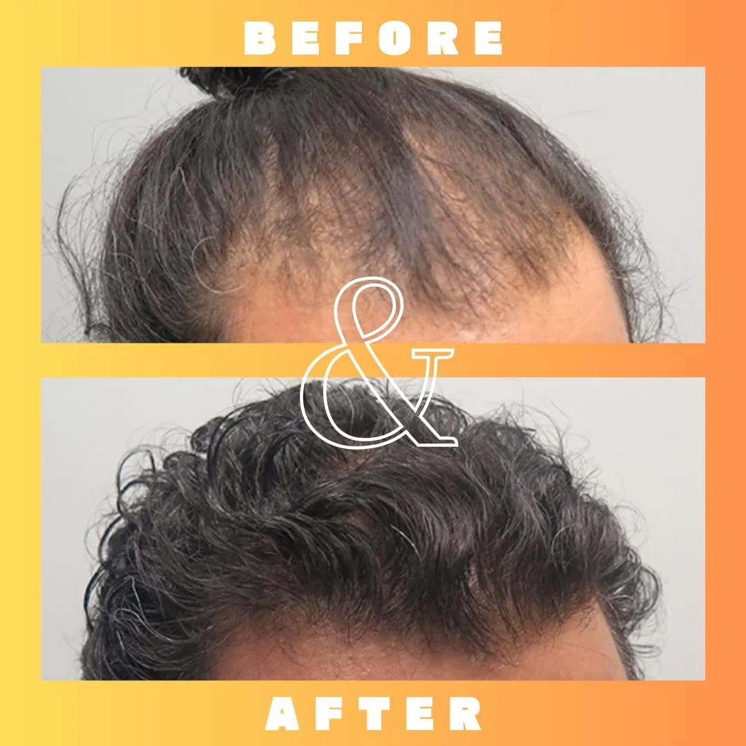 Розчин Mettle Mane RU58841 5% (50 мг/мл) - Передове лікування випадіння волосся, фото №5