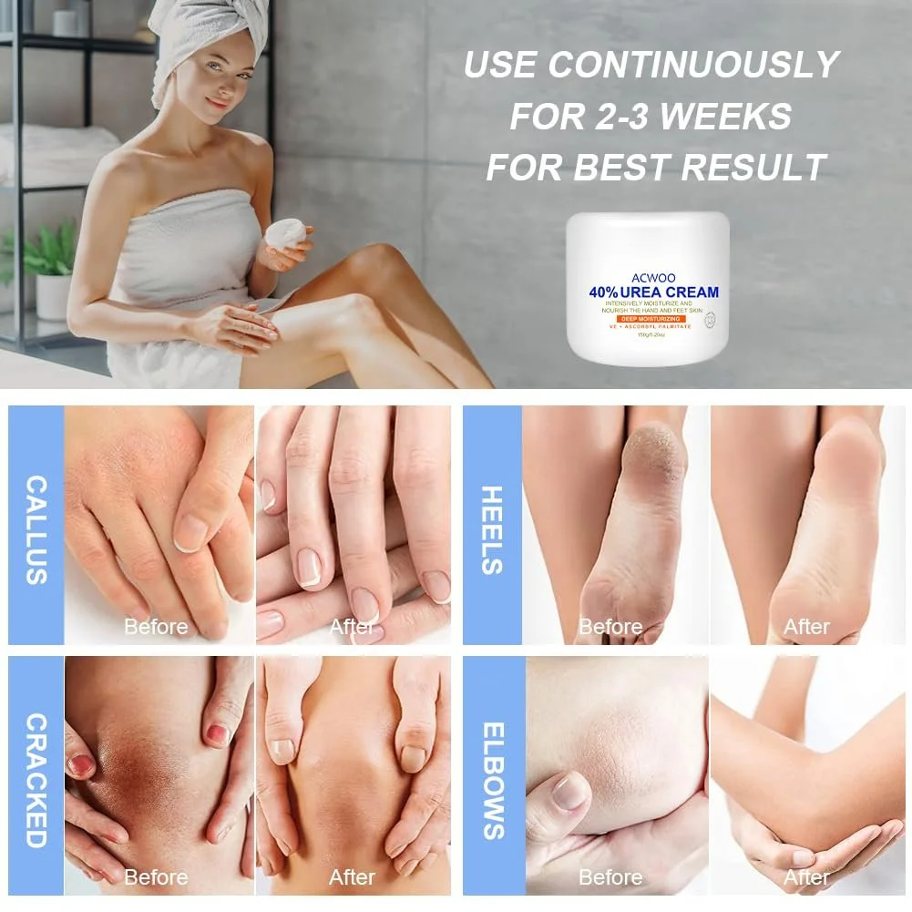 Крем для ног ACWOO Urea 40% интенсивный против мозолей 150 г, фото №3