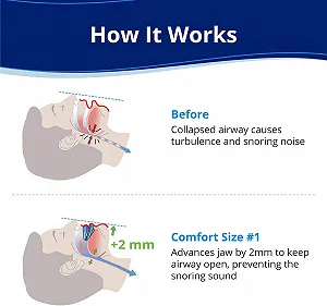Ротовий Апарат Проти Хропіння synthetic.ua - Фото 1