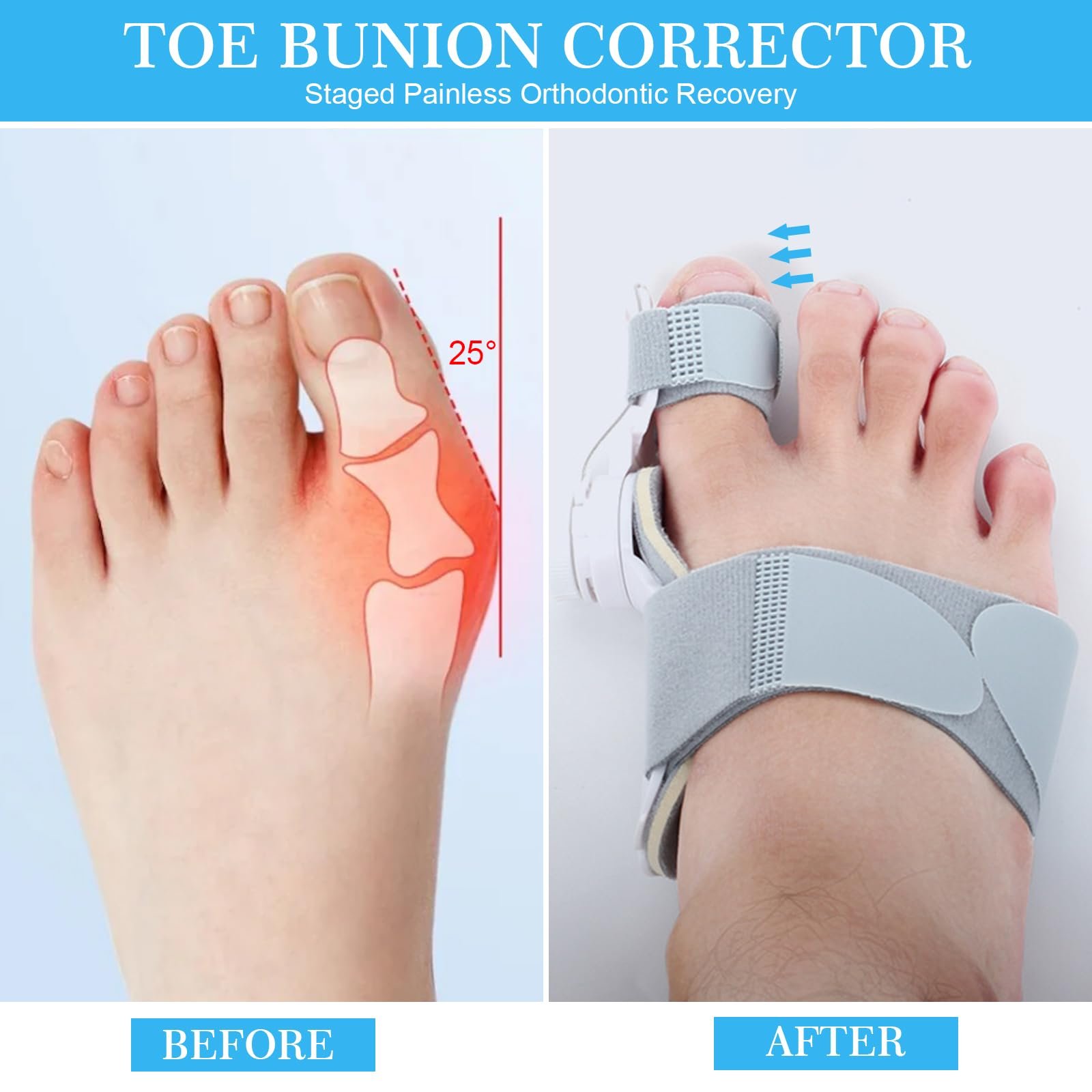 Коректор великого пальця стопи TWSOUL Hallux Valgus з 3 різними кутами кріплення, фото №3 Коректор великого пальця стопи TWSOUL Hallux Valgus з 3 різними кутами кріплення, фото №3