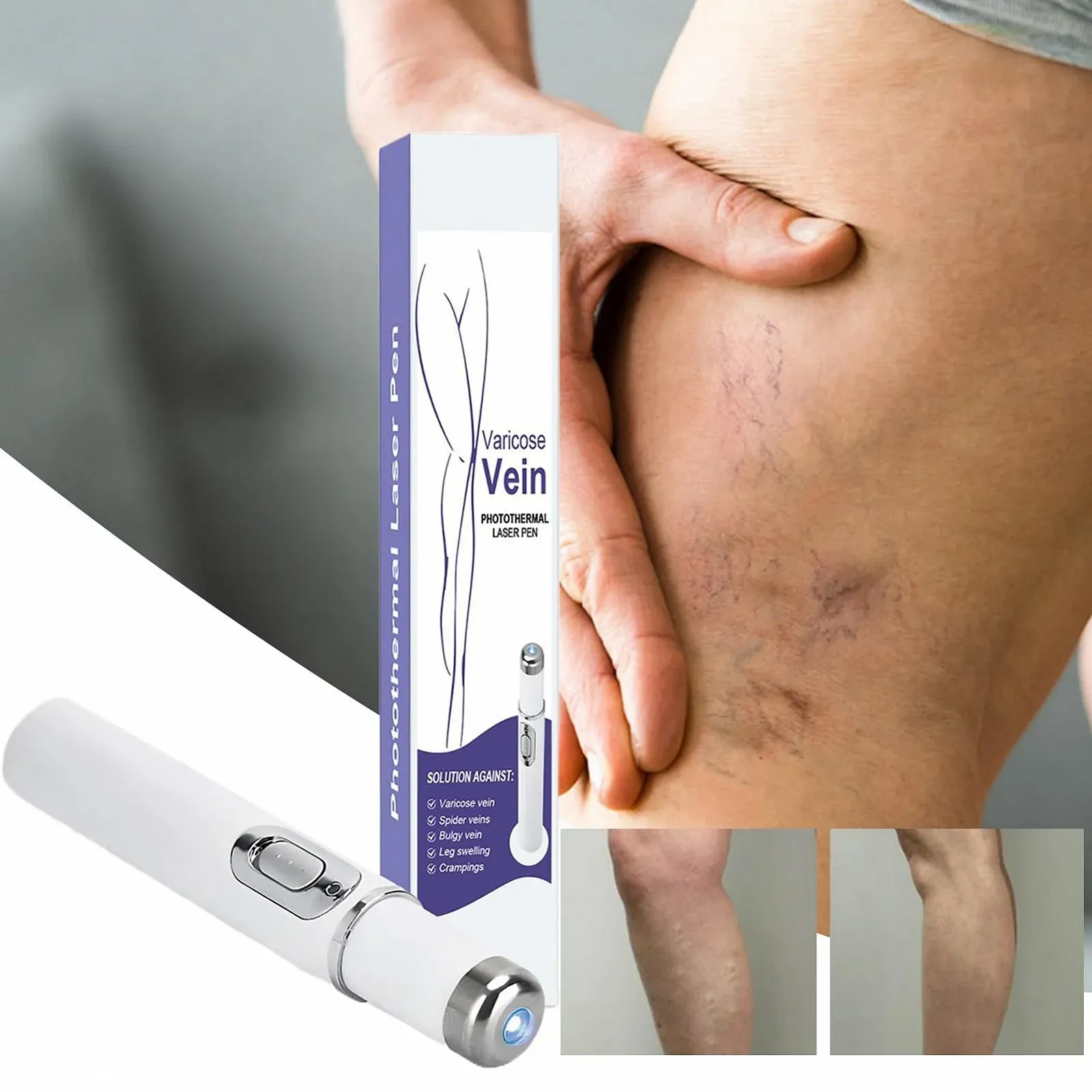 Прибор для удаления сосудистых звездочек Spider Vein Removal Pen портативный, фото №2