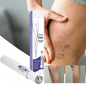 Прибор для удаления сосудистых звездочек Spider Vein Removal Pen портативный synthetic.ua - Фото 1