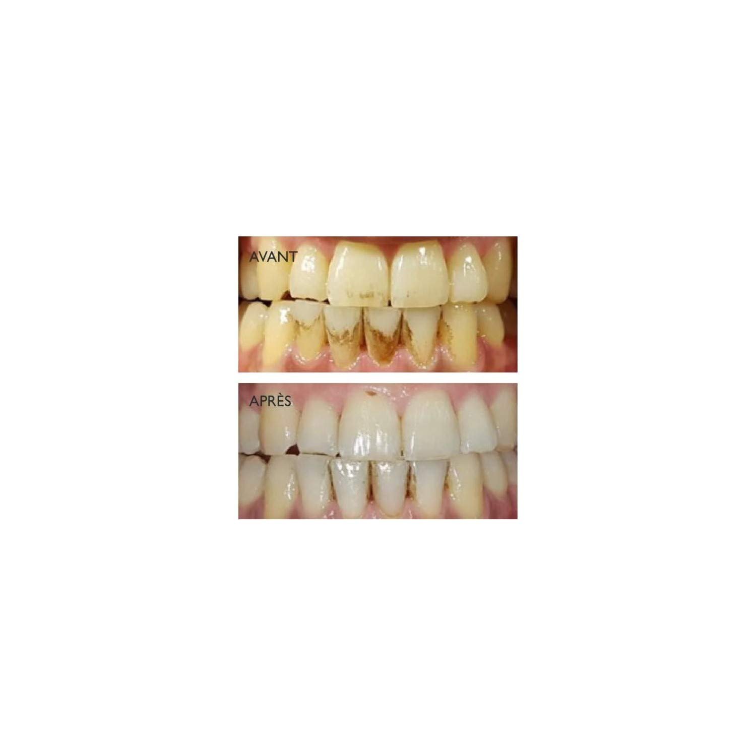 Високочастотна зубна щітка Silk'n ToothWave 4 рівні інтенсивності, фото №4