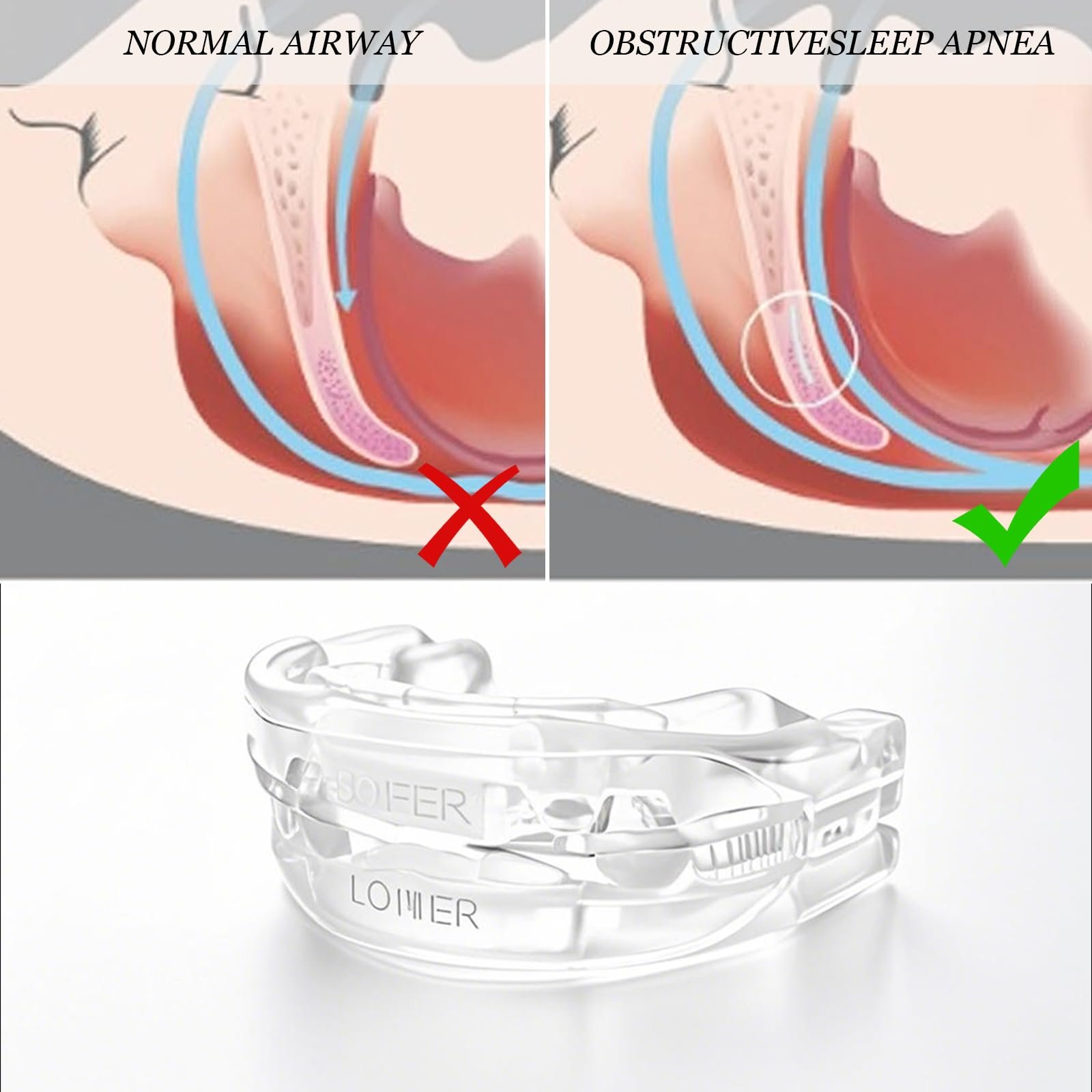 Капа від хропіння, Стопер, фото №7 Капа від хропіння, Стопер, фото №7