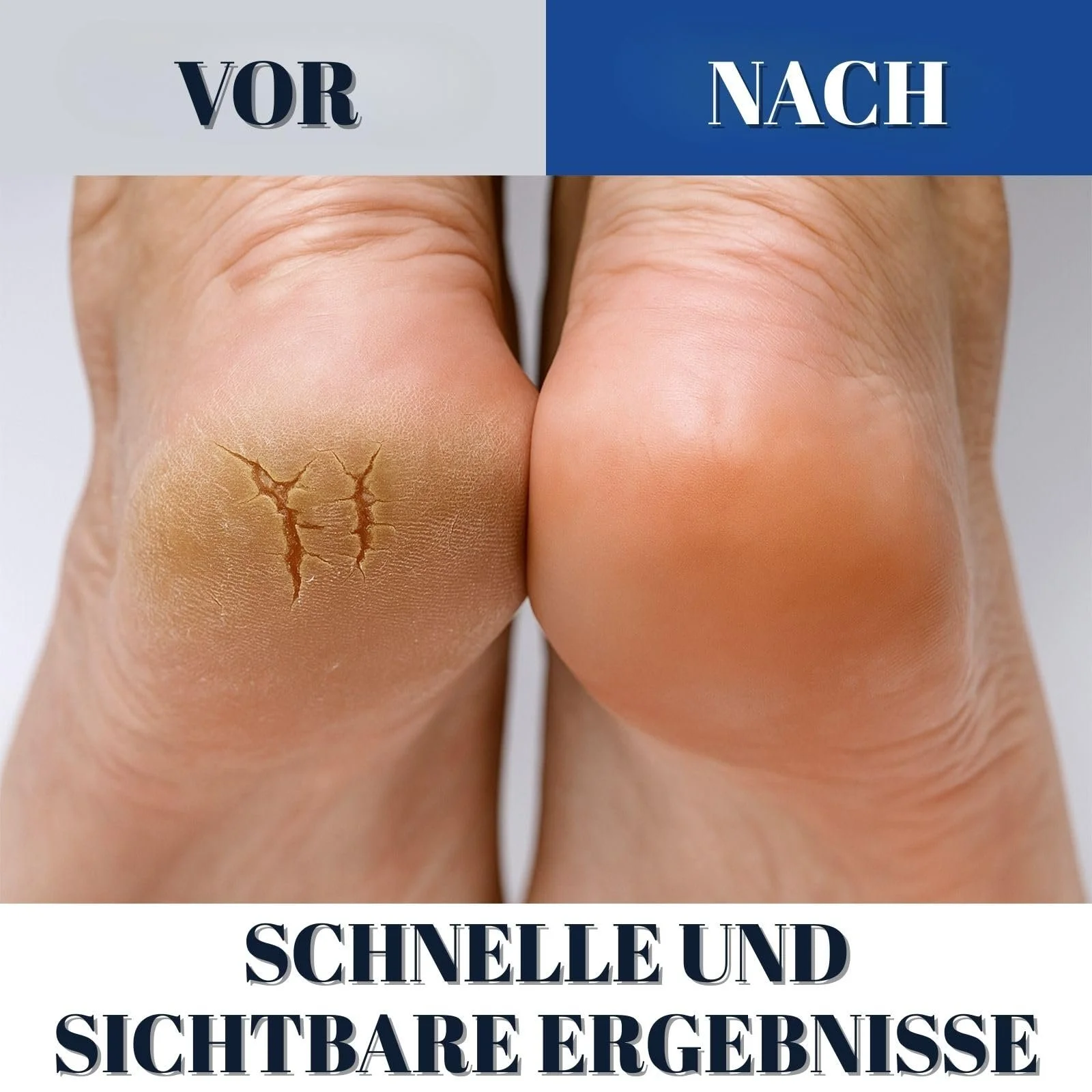 Крем для ног и тела Urea 40% & 2% Salic интенсивный от мозолей 100 г, фото №6