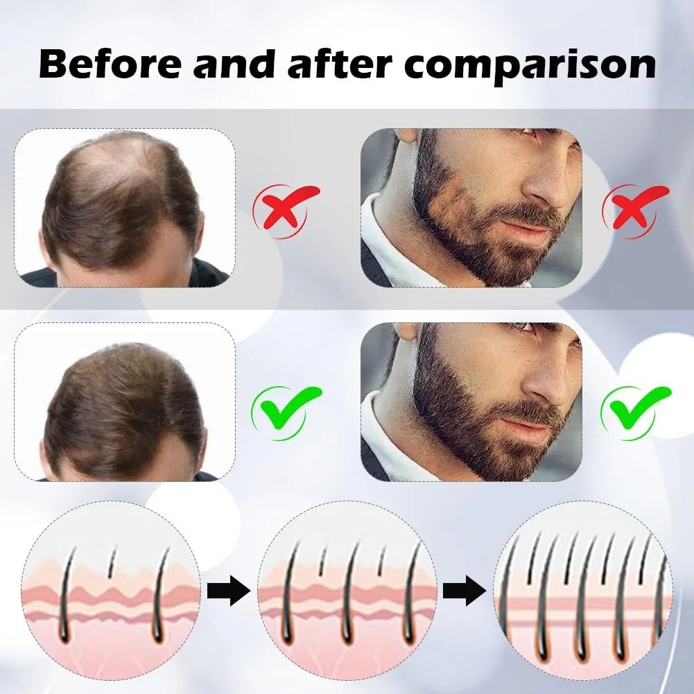 Дермаролер 0,5 мм, професійний мікронідлінг з 1200 справжніми титановими голками для волосся, обличчя, фото №4