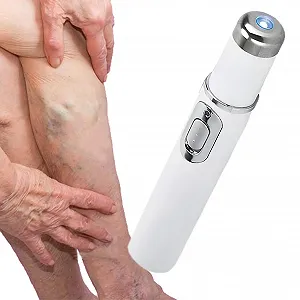 Карандаш для удаления сосудистых звездочек Portable Vein Pen для ног - Фото 1