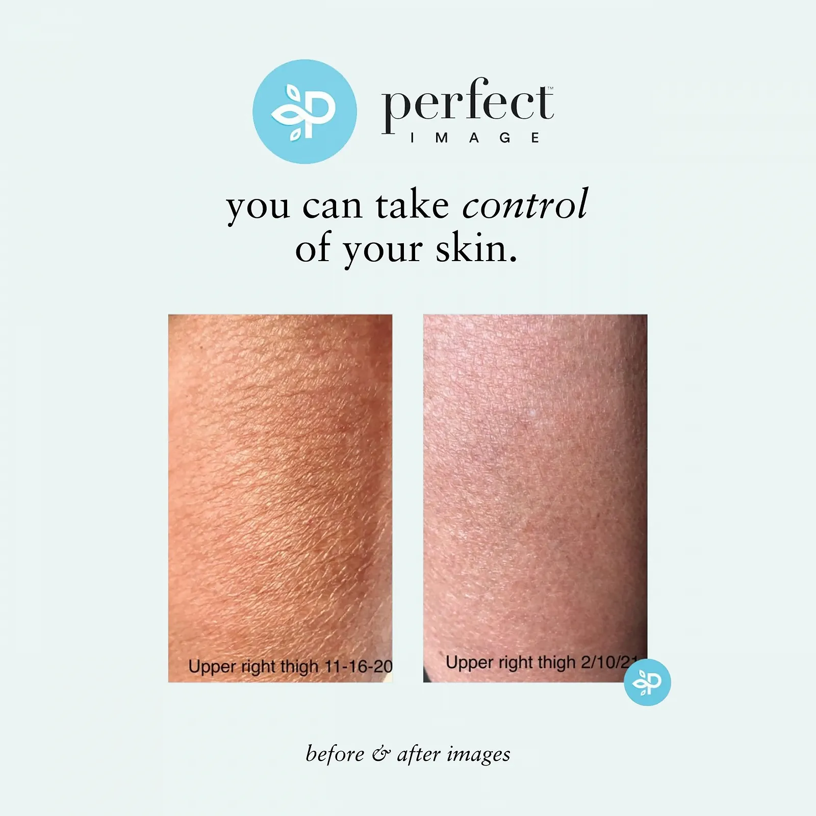 Лосьйон для тіла Perfect Image з Gly 10% + Sal 2%, фото №8