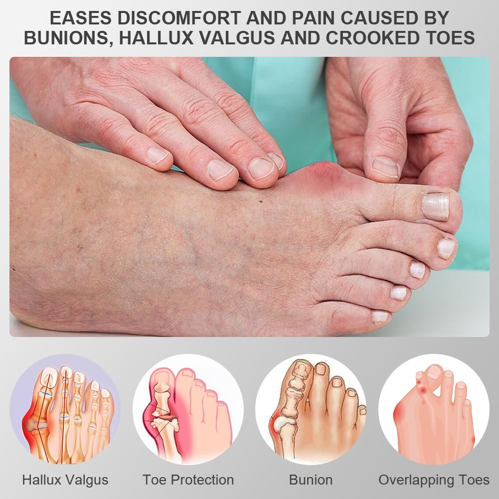 Шина для корекції Hallux Valgus ACWOO, 2 шини для корекції та 2 роздільники для пальців, нековзний, фото №2