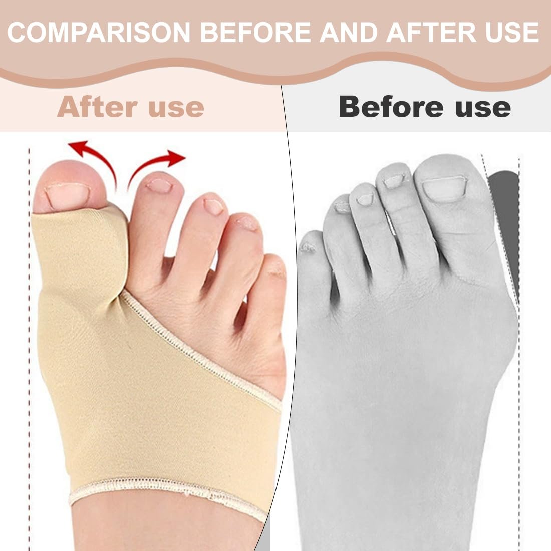 Пов'язка Hallux Valgus Комплект з 2 шт. Корекція і знеболення для чоловіків і жінок | М'який SEBS гель і дихаюча пов'язка, фото №5