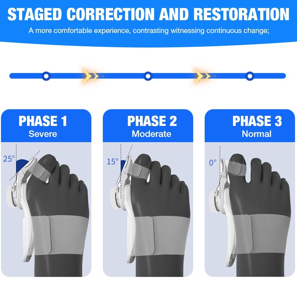 Шина для коррекции Hallux Valgus, регулируемая, обновленная, корректор большого пальца стопы, фото №4