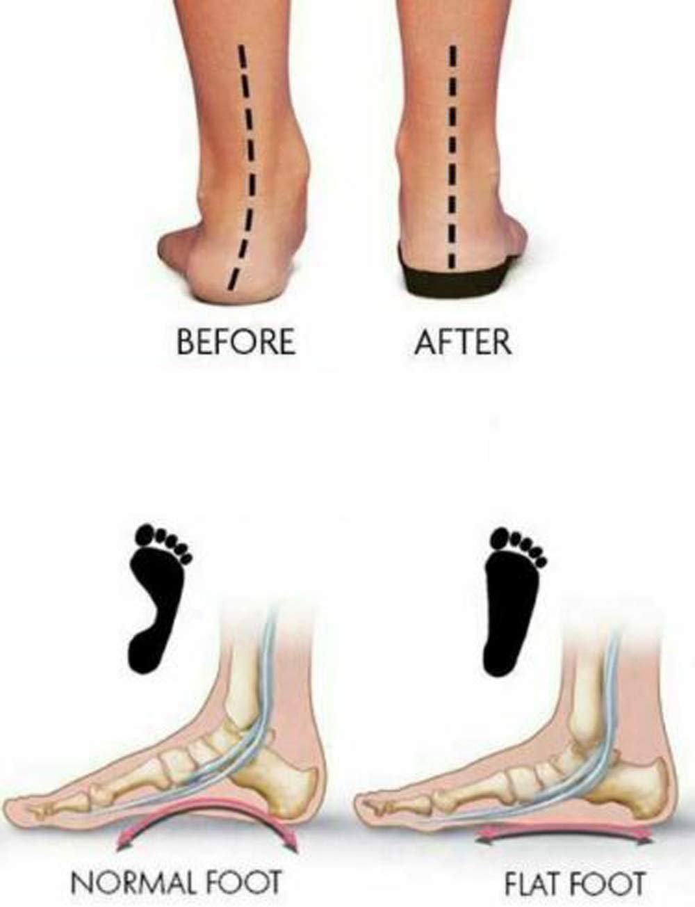 Роздільник для великого пальця стопи Ортопедичний Коректор Бурси 2.0 Бежевий, фото №3