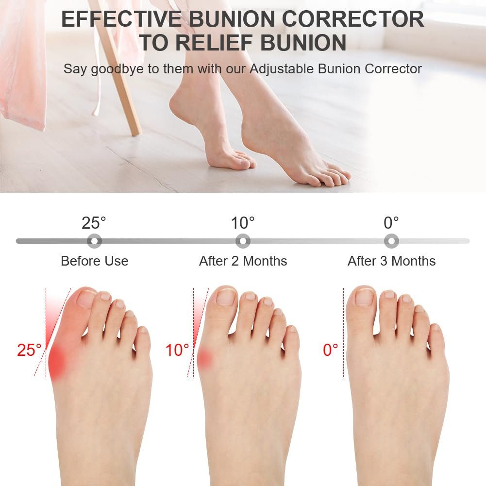 Шина для корекції Hallux Valgus ACWOO, 2 шини для корекції та 2 роздільники для пальців, нековзний, фото №3