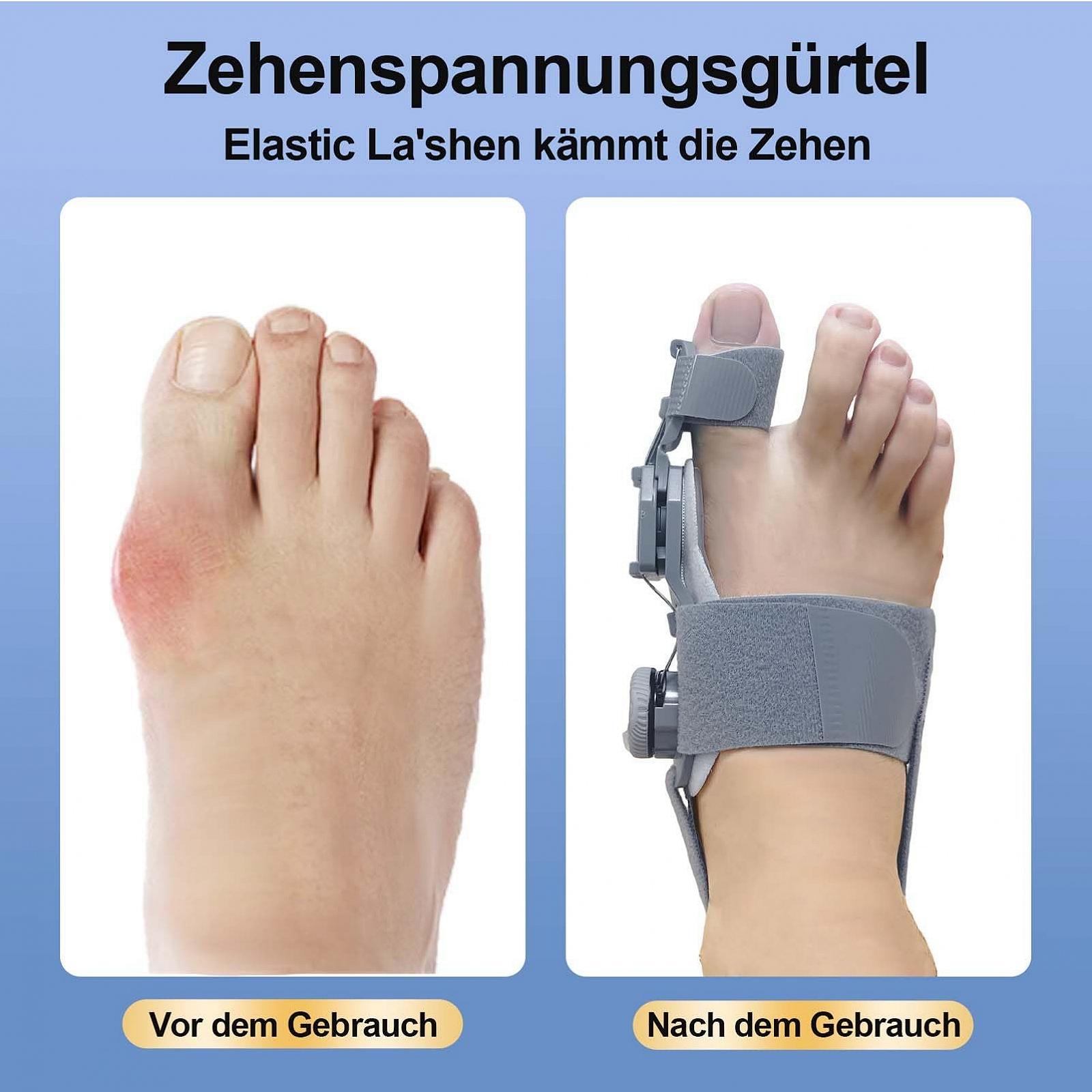 Шина для корекції Hallux Valgus Yeelan, шина Hallux Valgus з 2 силіконовими ремінцями, фото №6 Шина для корекції Hallux Valgus Yeelan, шина Hallux Valgus з 2 силіконовими ремінцями, фото №6