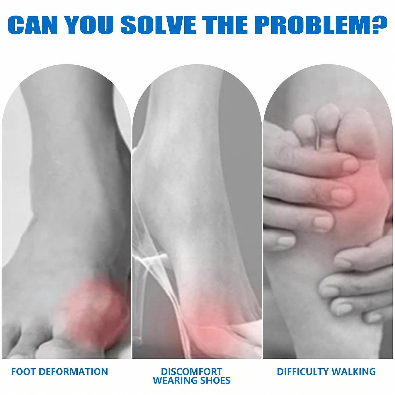 Корректор большого пальца стопы 1 пара для мужчин и женщин, регулируемый удобный для левой и правой ноги, облегчение боли Hallux Valgus, фото №2