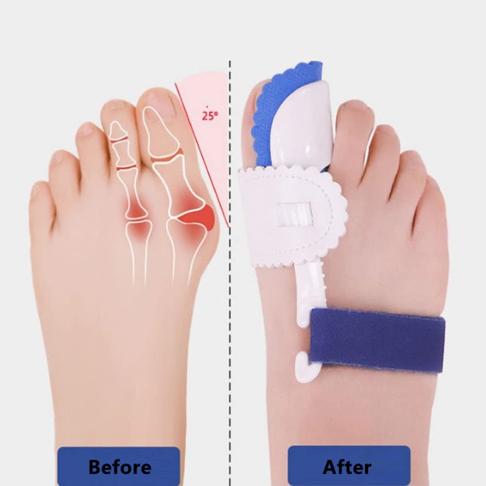 Роздільник для пальців ніг (2 шт.) Hallux Valgus Corrector Коректор кісточки на великому пальці ноги, фото №2