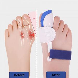 Роздільник для пальців ніг (2 шт.) Hallux Valgus Corrector Коректор кісточки на великому пальці ноги synthetic.ua - Фото 1