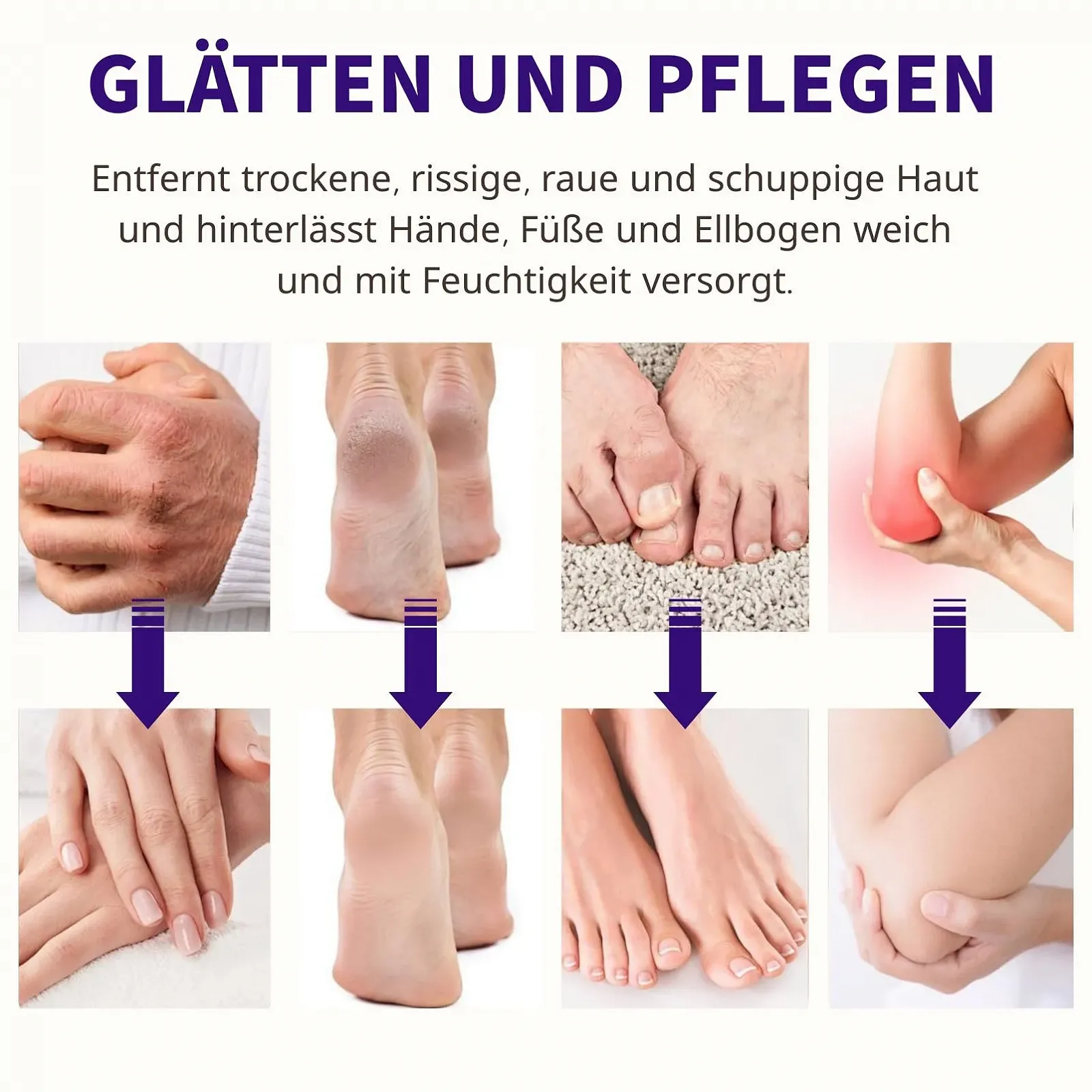 Крем для ног Urea Cream 40% от мозолей и трещин для сухой кожи стоп, рук и локтей, фото №6 Крем для ног Urea Cream 40% от мозолей и трещин для сухой кожи стоп, рук и локтей, фото №6