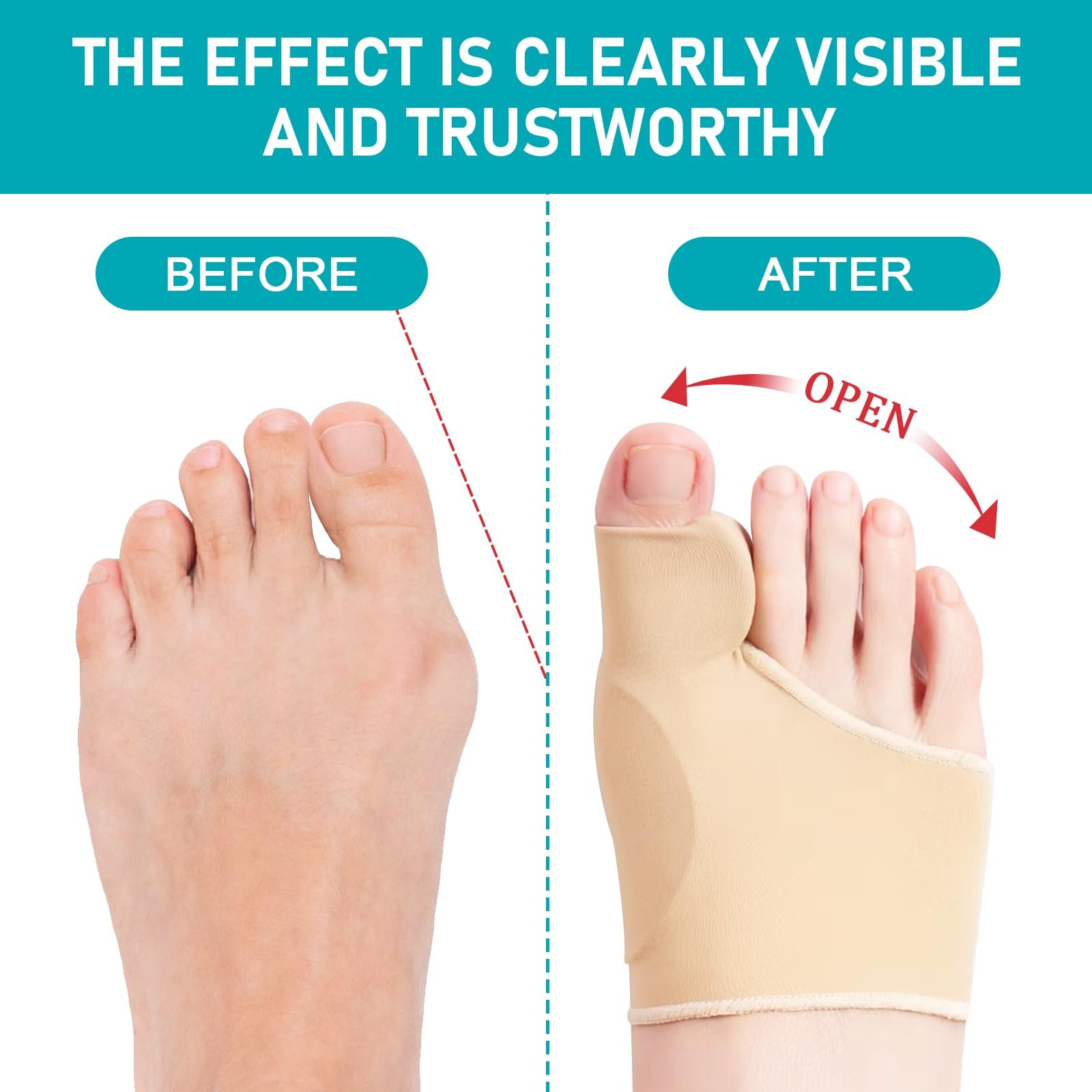 Носки Hallux Valgus, Коррекция Hallux Valgus, Корректор большого пальца стопы Hallux Valgus, Повязка для большого пальца стопы, Повязка Hallux Valgus с силиконовыми подушечками для мужчин и женщин (37-43 M, телесный цвет), фото №2