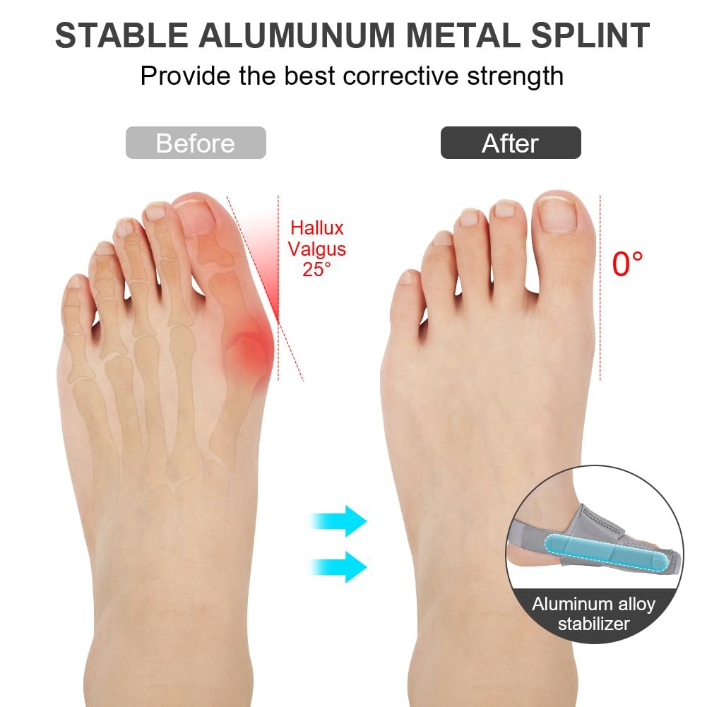 Шина для корекції Hallux Valgus ACWOO, 2 шини для корекції та 2 роздільники для пальців, нековзний, фото №4