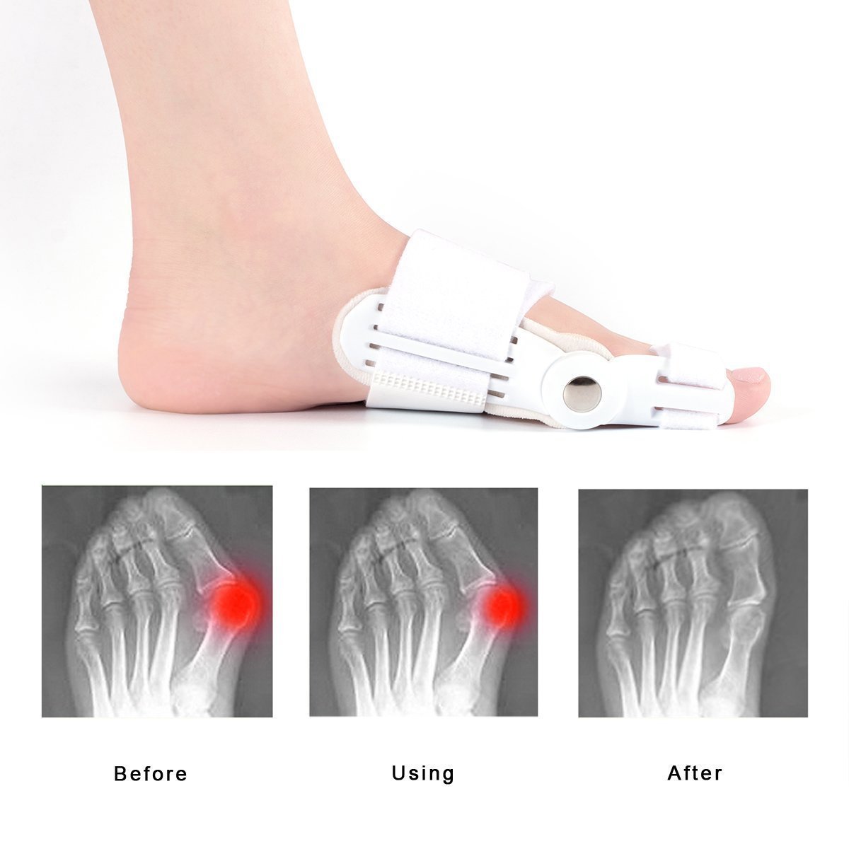 Шина для великого пальця стопи Ортопедична Hallux Valgus 2 шт Hallux Valgus Correction Pads, фото №4
