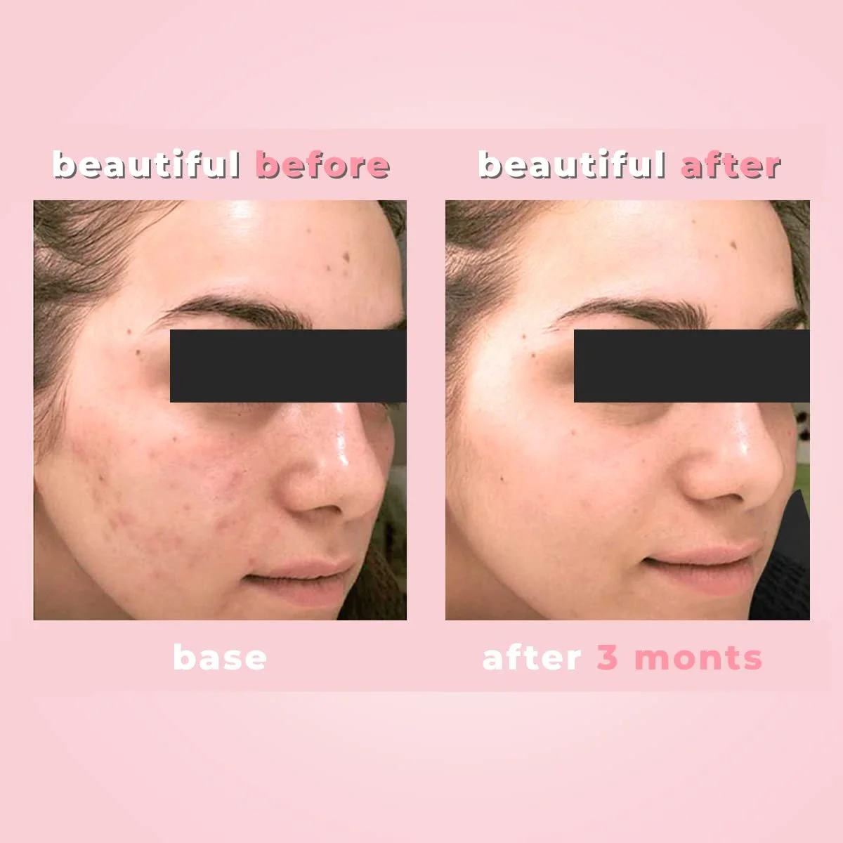 Набір Biotrade Acne Out 3 Easy Steps Засіб для лікування акне для здорової шкіри, фото №7