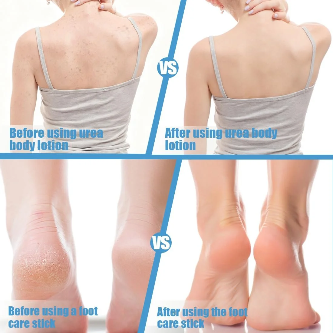 Лосьон для тела и крем для ног Urea 60% мочевины и 2% салициловой кислоты, фото №5