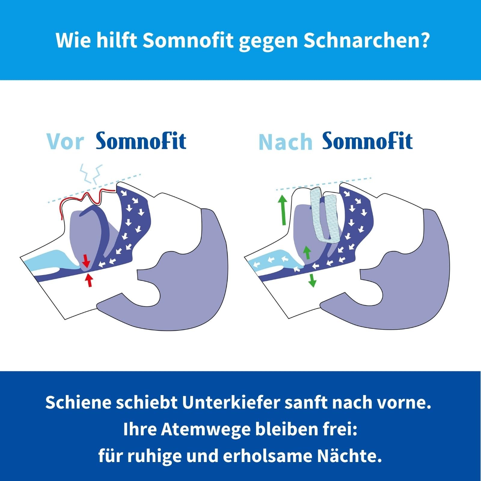 Щиток від хропіння SomnoFit Швейцарський, фото №4 Щиток від хропіння SomnoFit Швейцарський, фото №4