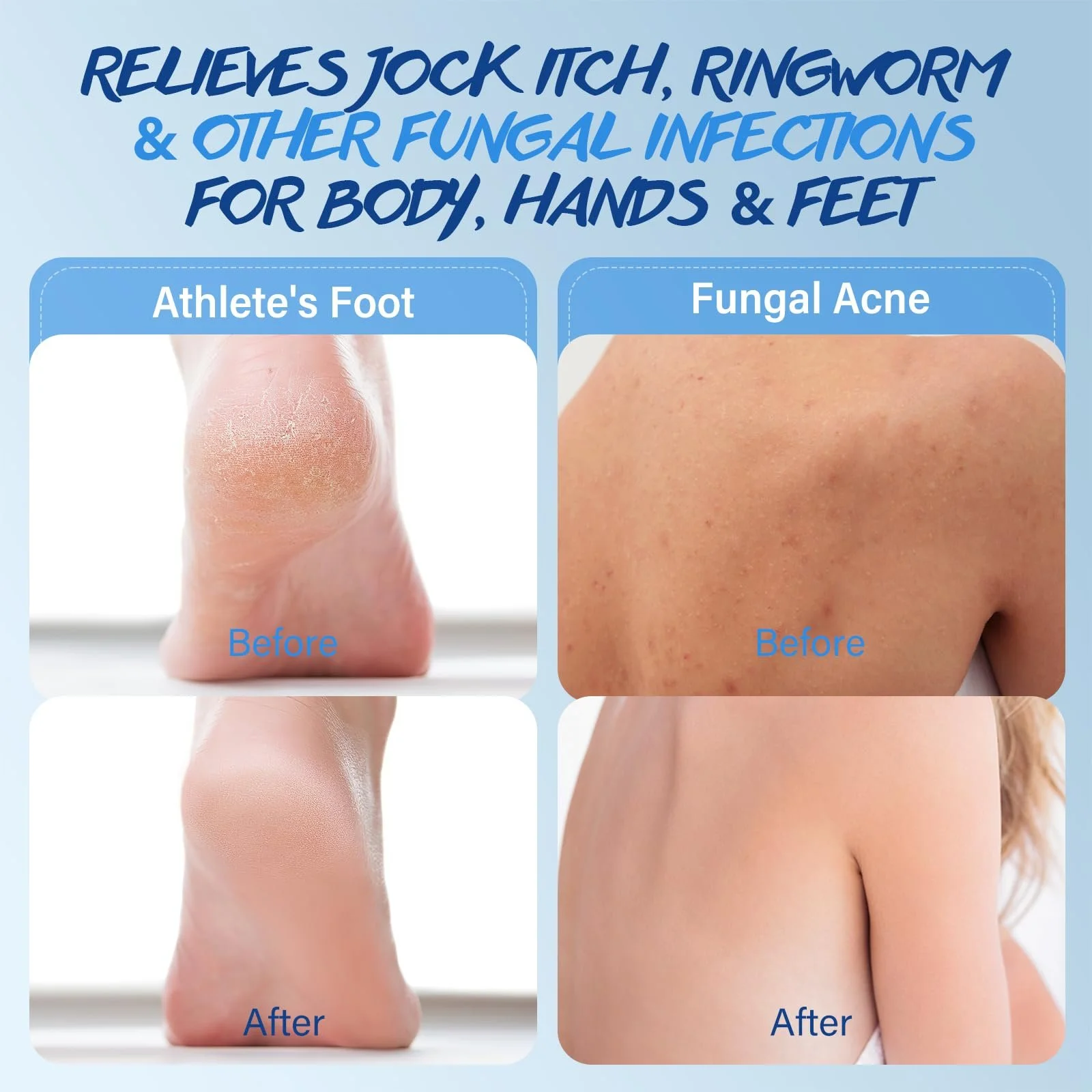 Противогрибковый крем с маслом чайного дерева 100 г, фото №3 Противогрибковый крем с маслом чайного дерева 100 г, фото №3