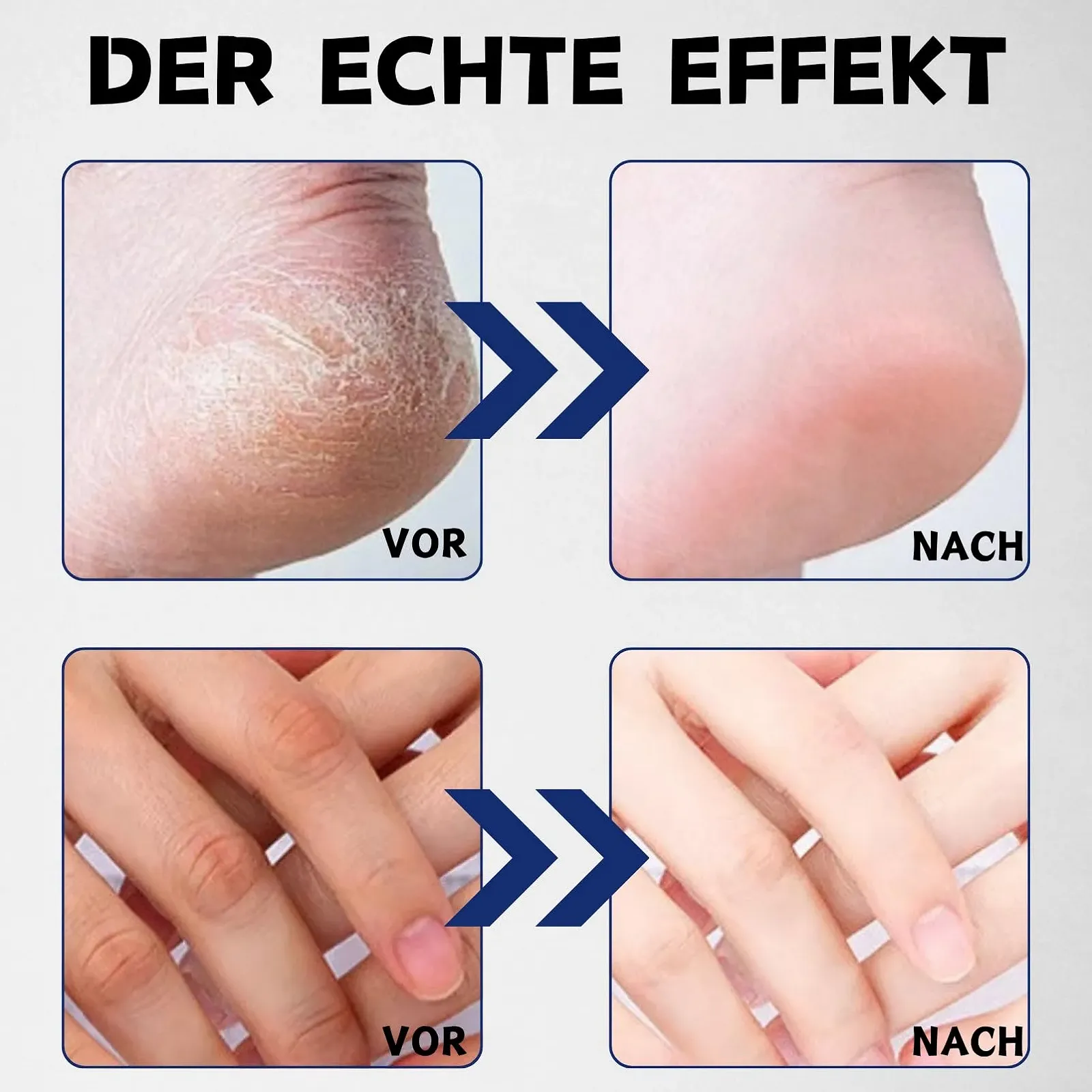 Крем для ног Urea 40% против мозолей и трещин интенсивно увлажняющий 150 г, фото №7