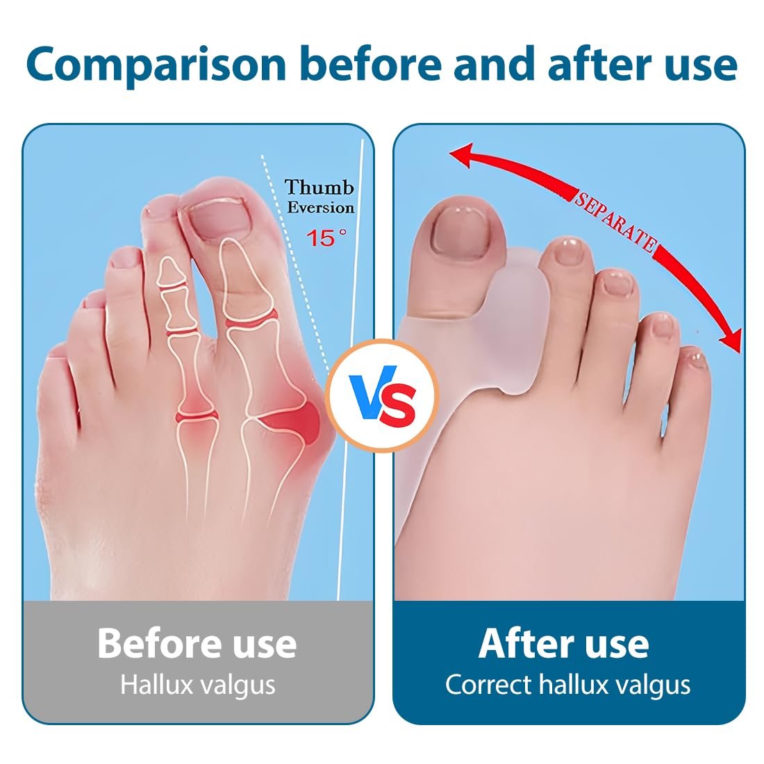 Роздільник для корекції великого пальця стопи Hallux Valgus, м’який гелевий, фото №4 Роздільник для корекції великого пальця стопи Hallux Valgus, м’який гелевий, фото №4