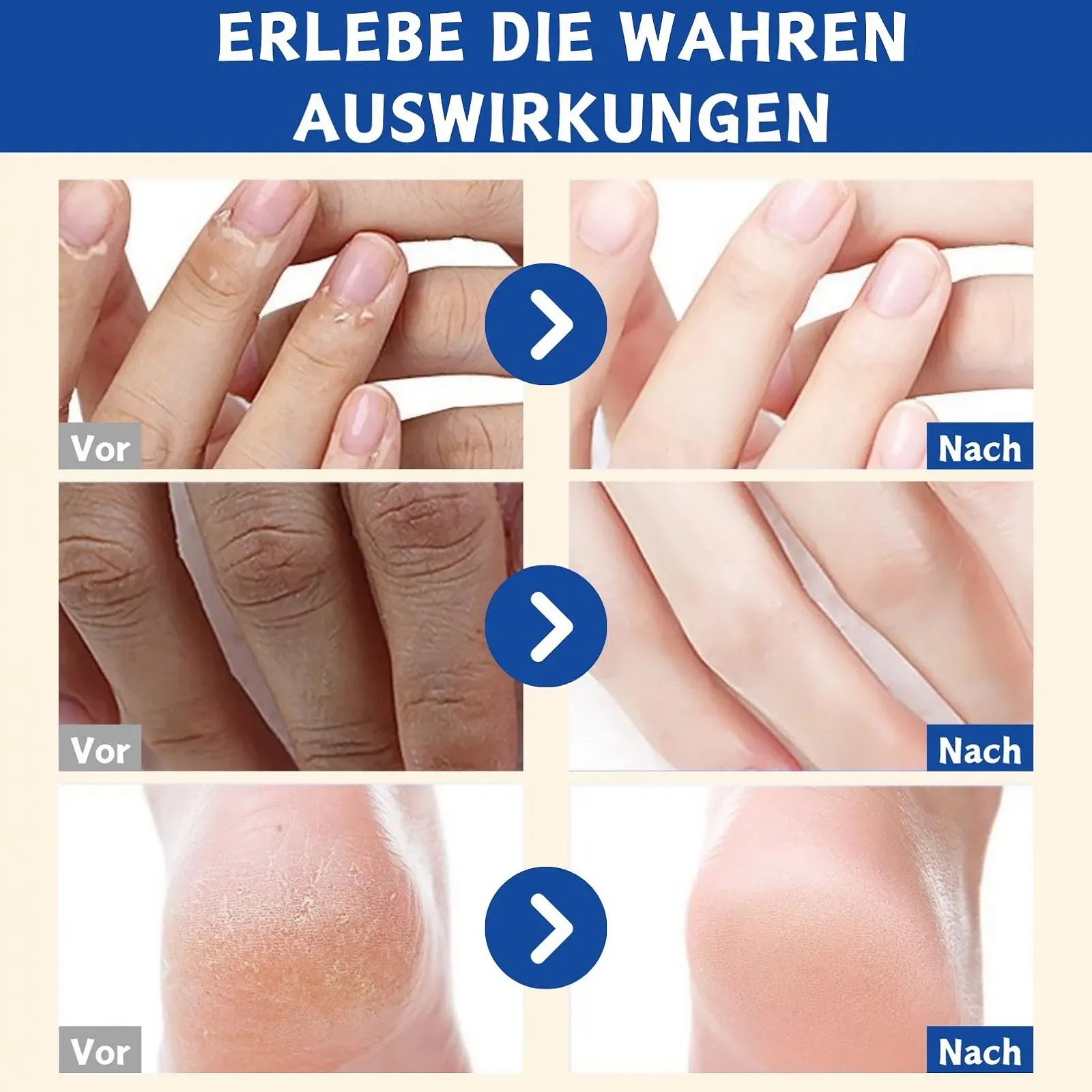 Крем-стик для ног Urea 60% с салициловой кислотой от мозолей и трещин 2 x 40 г, фото №7