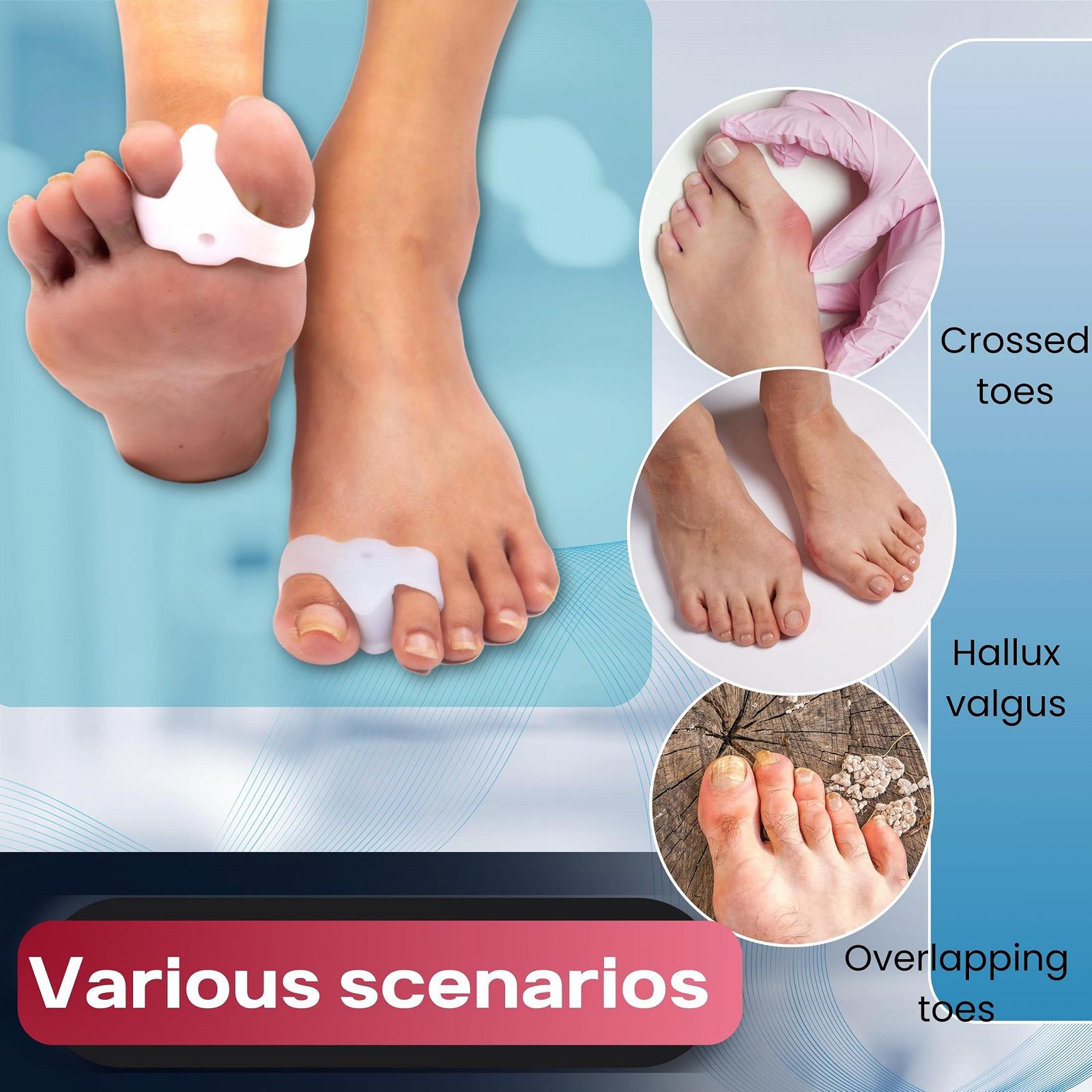 Роздільник для пальців ніг Wonder Care Силіконові гелеві подушечки для стоп, фото №3 Роздільник для пальців ніг Wonder Care Силіконові гелеві подушечки для стоп, фото №3