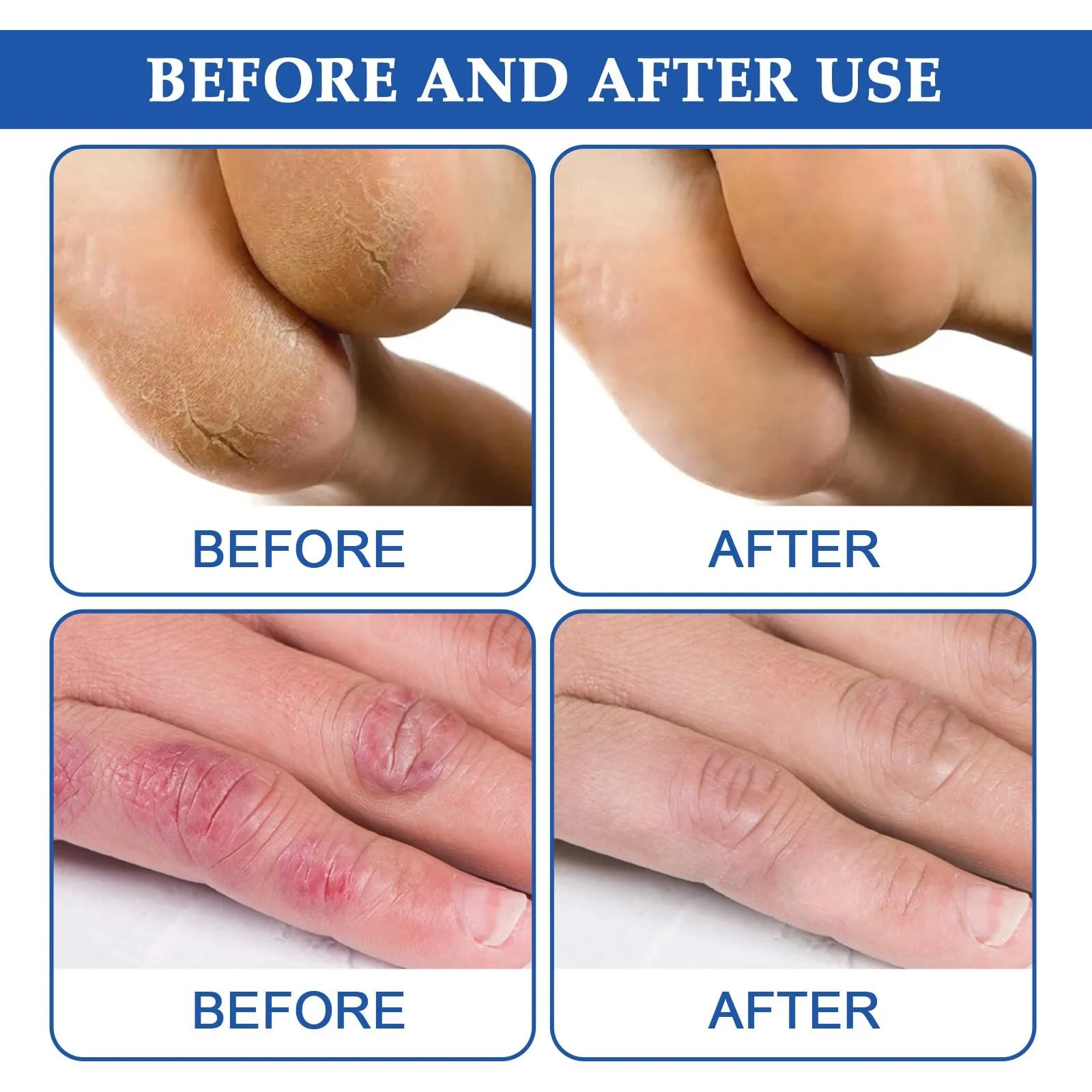 Восстанавливающий крем для ног и рук с гиалуроновой кислотой, 20 г, 1 шт., фото №5 Восстанавливающий крем для ног и рук с гиалуроновой кислотой, 20 г, 1 шт., фото №5