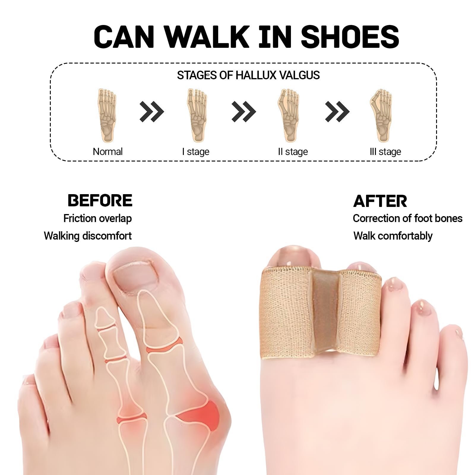 Роздільник для пальців ніг (6 шт.) Hallux Valgus, знеболення при молоткоподібних пальцях, фото №3