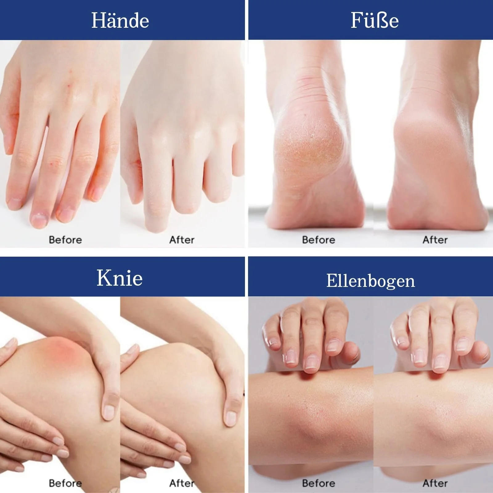 Крем для ног и рук Urea 40% против мозолей 40% мочевины, фото №7