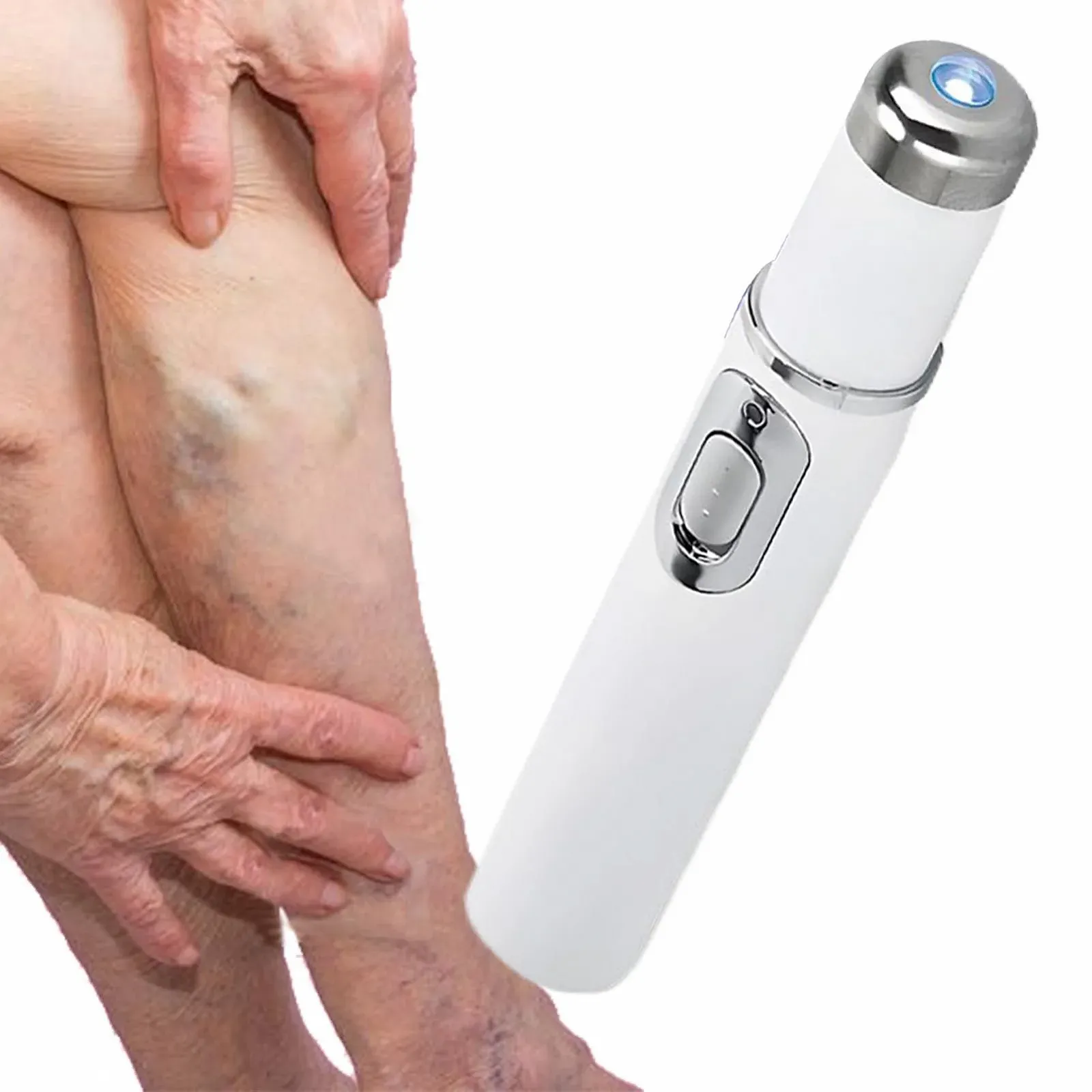 Прибор для удаления сосудистых звездочек Spider Vein Removal Pen портативный, фото №7