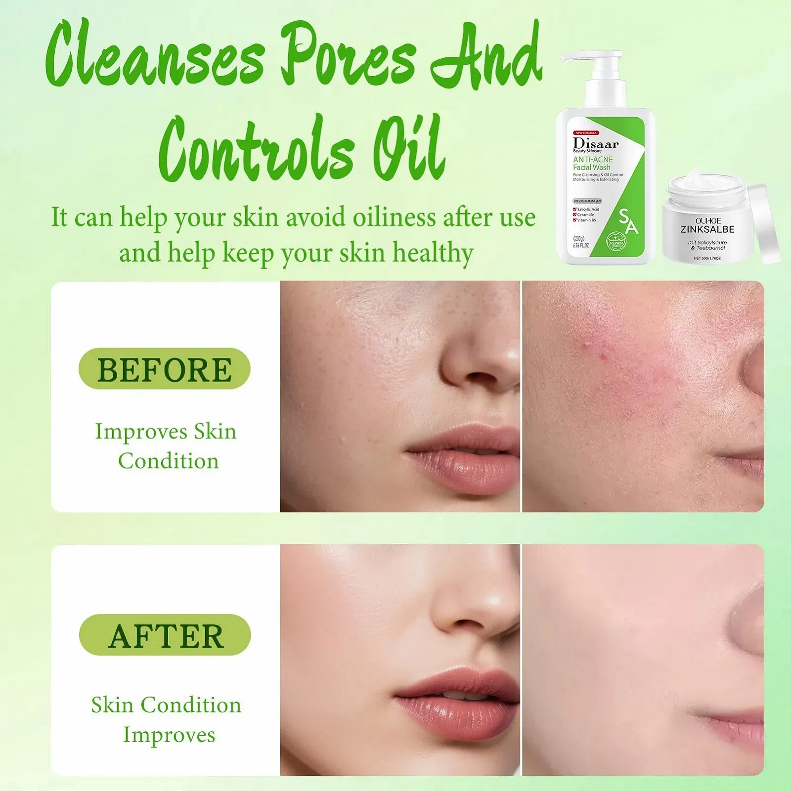 Набір проти прищів з цинковою маззю, з цинковою маззю та пінним очищувальним гелем, фото №3