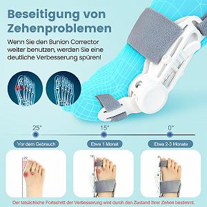 Коректор великого пальця стопи Epessa Hallux Valgus Correction Upgrade Регульована шина Кронштейни Hallux Valgus для пальців ніг вдень і вночі для чоловіків і жінок synthetic.ua - Фото 1