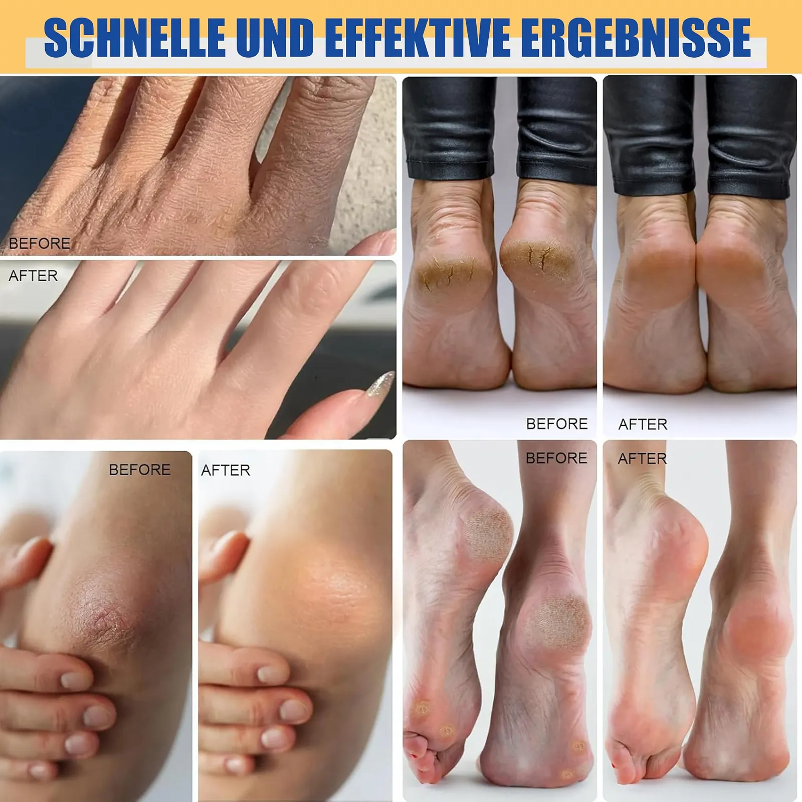 Крем-стик для ног увлажняющий против трещин с мочевиной 60% и пилкой Blue 40 г + 40 г, фото №4