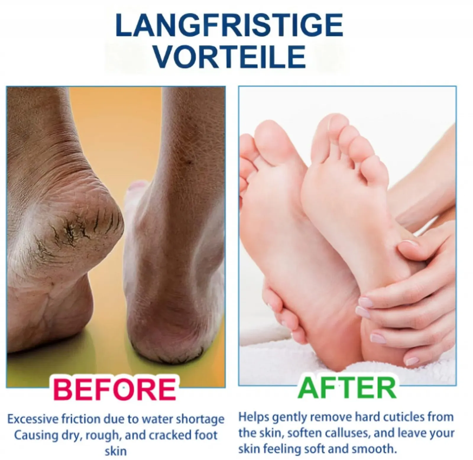 Крем Urea Cream с мочевиной 60% и салициловой кислотой 2% против мозолей, фото №5 Крем Urea Cream с мочевиной 60% и салициловой кислотой 2% против мозолей, фото №5