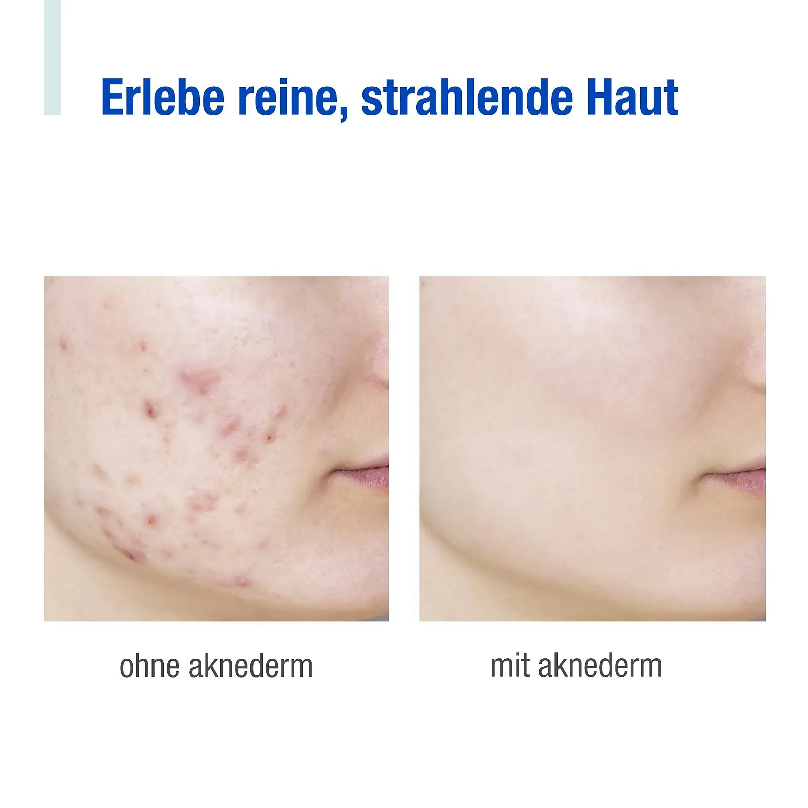 Маска для лица Aknederm Pure Очищающая 12 x 6 мл I С экстрактом лотоса I Матовая маска из фарфоровой глины удаляет кожный жир I Маска для лица против блеска для тщательной очистки, фото №5