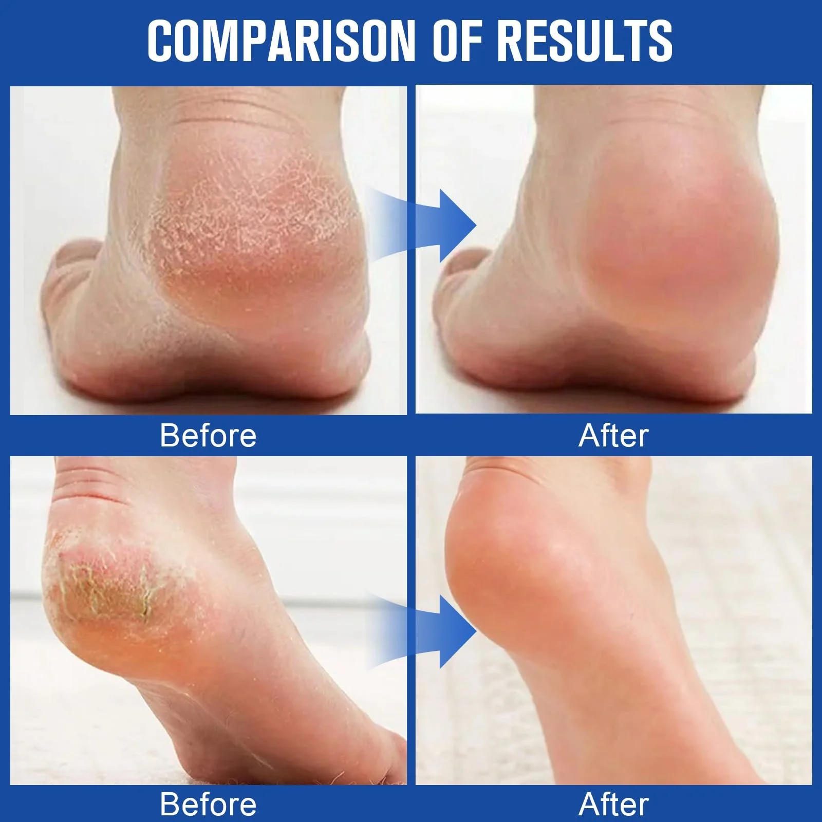 Увлажняющий крем для ног против трещин и натоптышей 60% Urea Набор 2 шт, фото №5 Увлажняющий крем для ног против трещин и натоптышей 60% Urea Набор 2 шт, фото №5