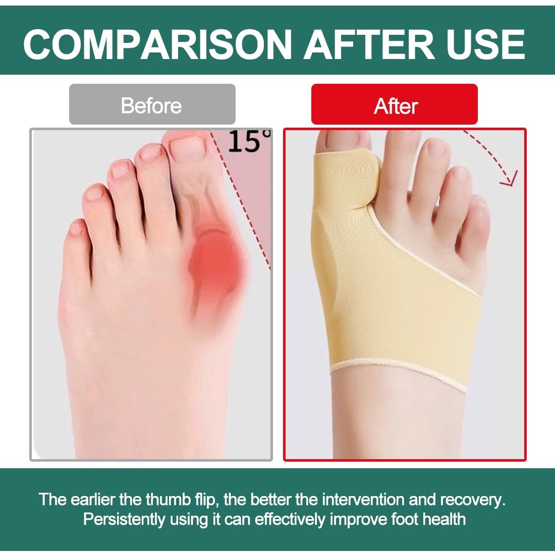 Шкарпетки для корекції великого пальця стопи Hallux Valgus, 2 пари, з силіконовими подушечками, роздільник для пальців, великий палець стопи, фото №3