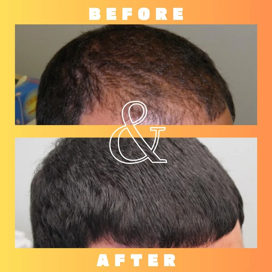 Розчин Mettle Mane RU58841 5% (50 мг/мл) - Передове лікування випадіння волосся, фото №4