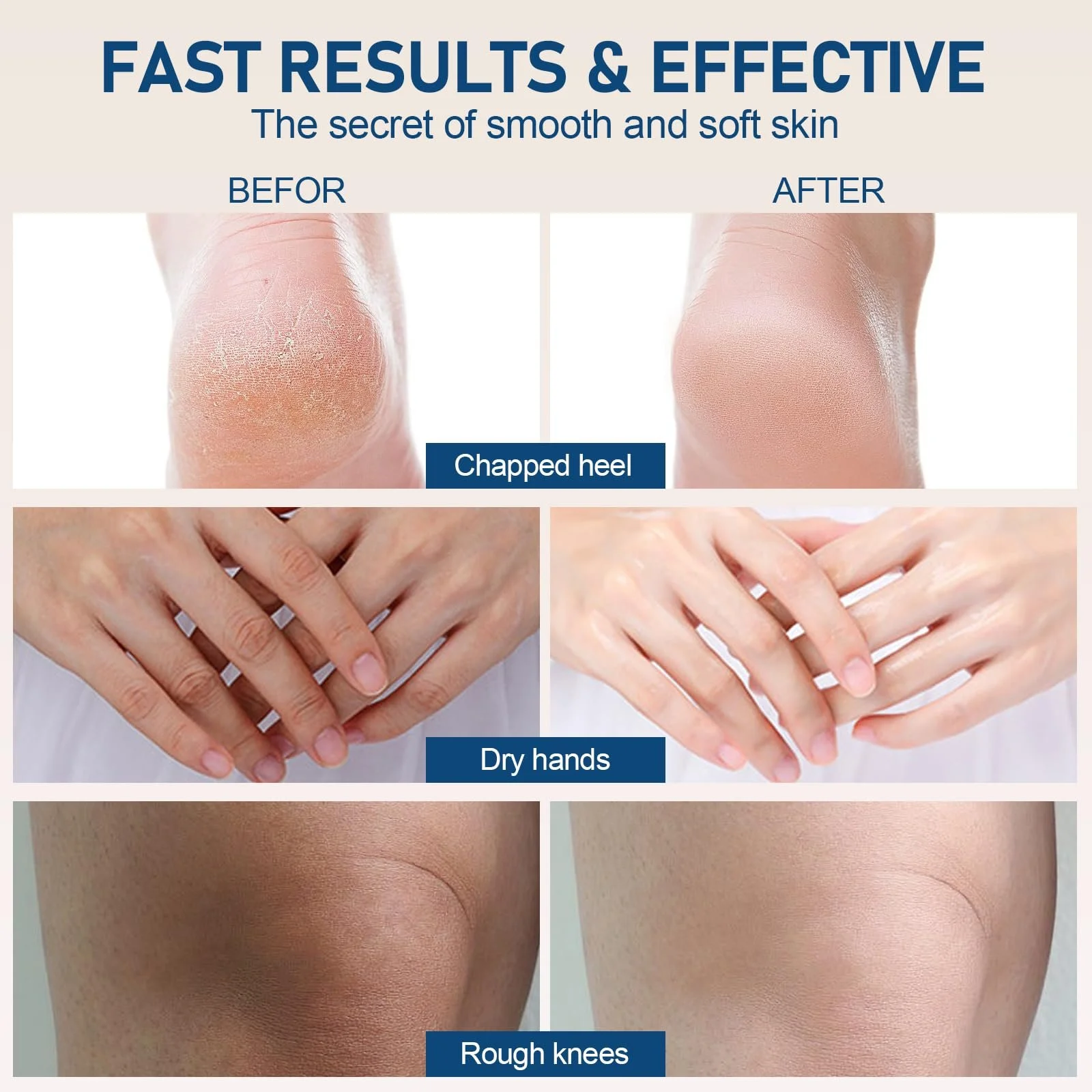 Крем для ног Urea Cream 40% интенсивный увлажняющий с гиалуроновой кислотой 150 г, фото №6